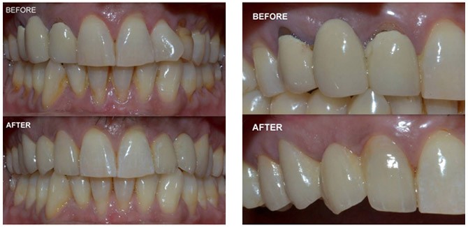 Dental Bridge Treatment in India Dental Bridge Treatment in India
