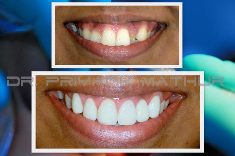 Smile Designing in Pune Smile Designing