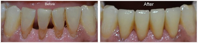 Ceramic Zirconia Caps in Pune India Dental Implants