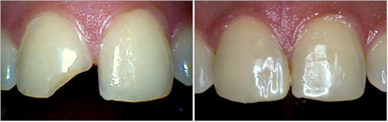 Composite Bonding Pune Composite Bonding Pune