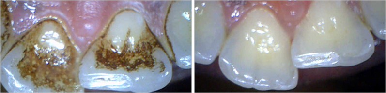 Cost of Teeth Cleaning In Pune Cost of Teeth Cleaning In Pune