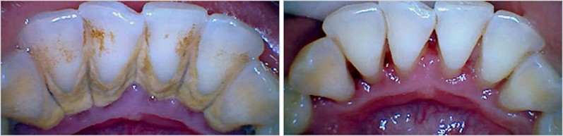 Scaling Polishing Teeth Cleaning Scaling Polishing Teeth Cleaning