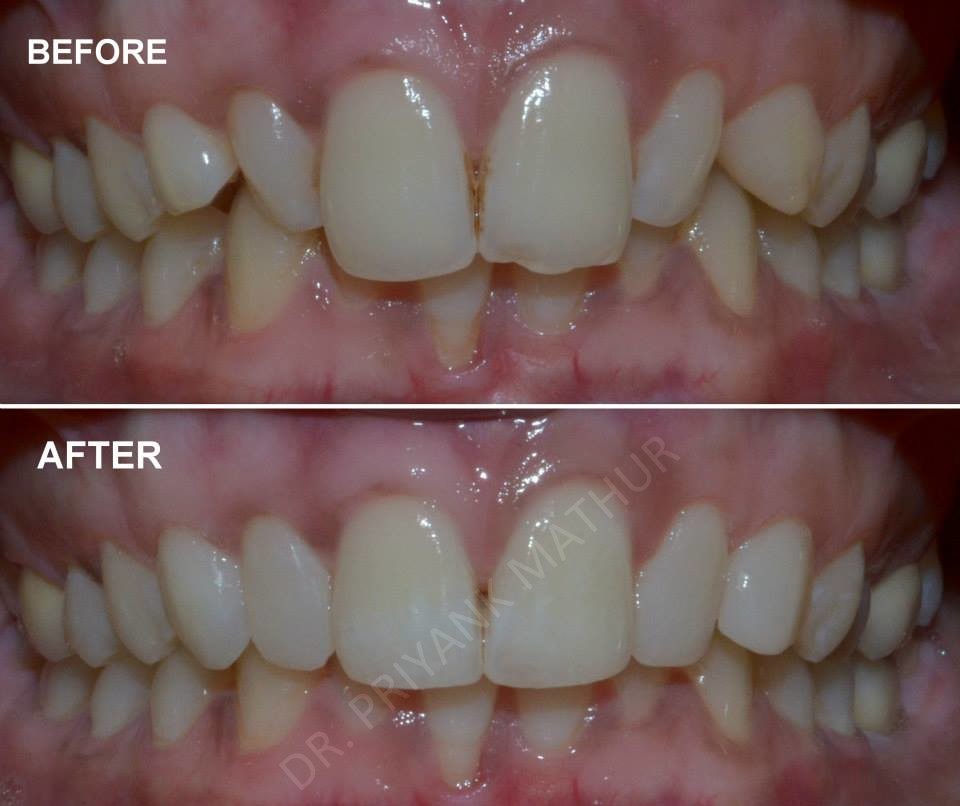 Affordable Smile Designing using Composite bonding &amp; Teeth 