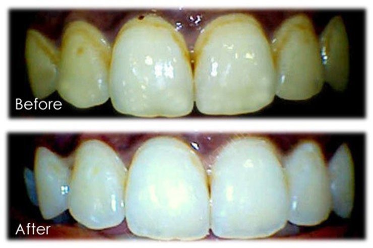 In office bleaching cases at Smilekraft Dentistry