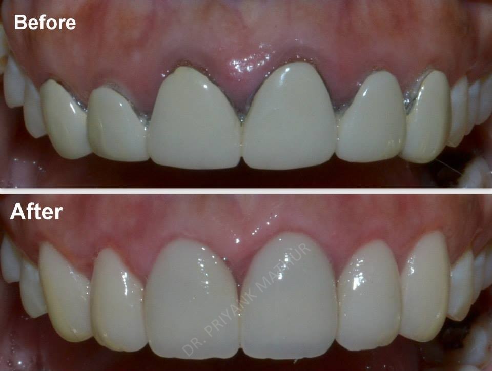 Replacing unaesthetic old crowns-2 - Smilekraft Dentistry