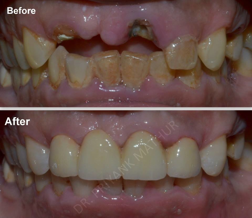 Teeth Replacement using Czar Zirconia Bridge-2 Teeth Replacement using Czar Zirconia Bridge