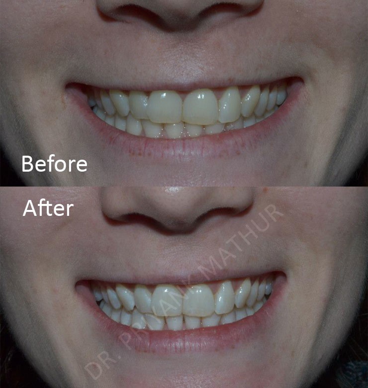 Teeth Whitening