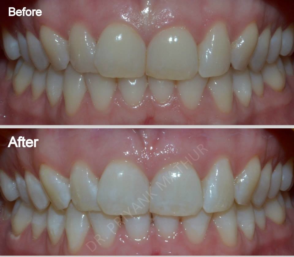 In office Teeth Whitening