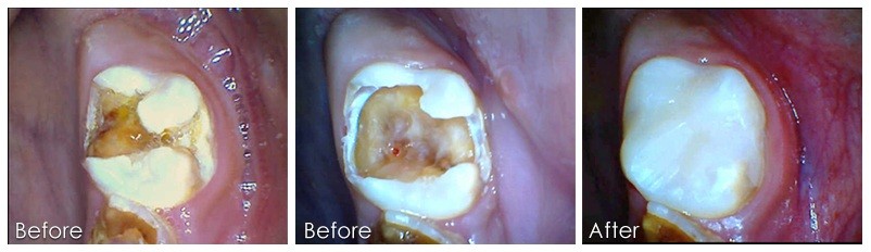 Dental filling Composite dental filling