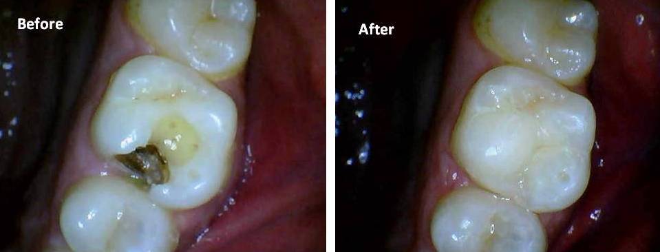 Dental Fillings Pune Direct Restorations