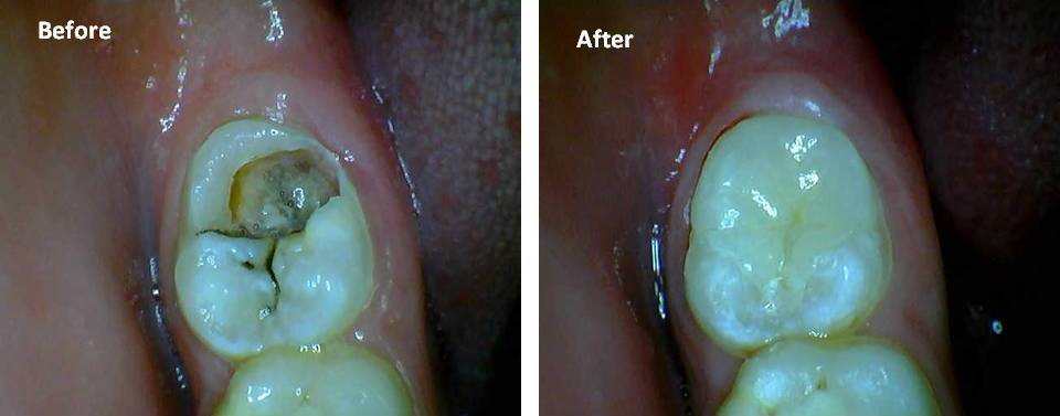 Tooth Fillings India