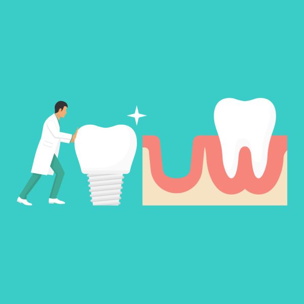 Dental implants and the big questions