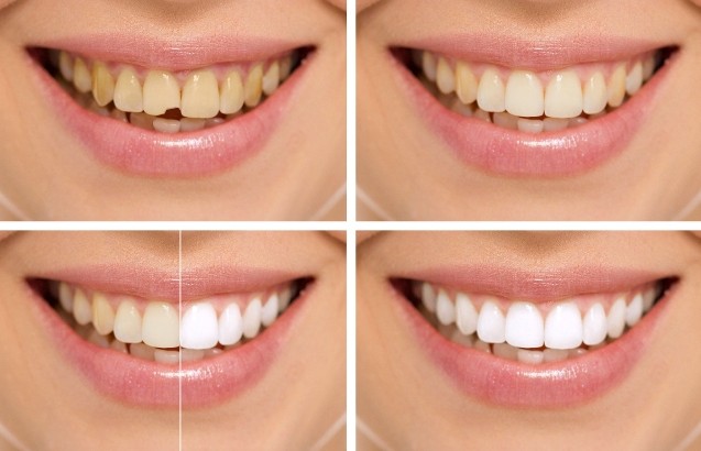 What does a smile makeover include_