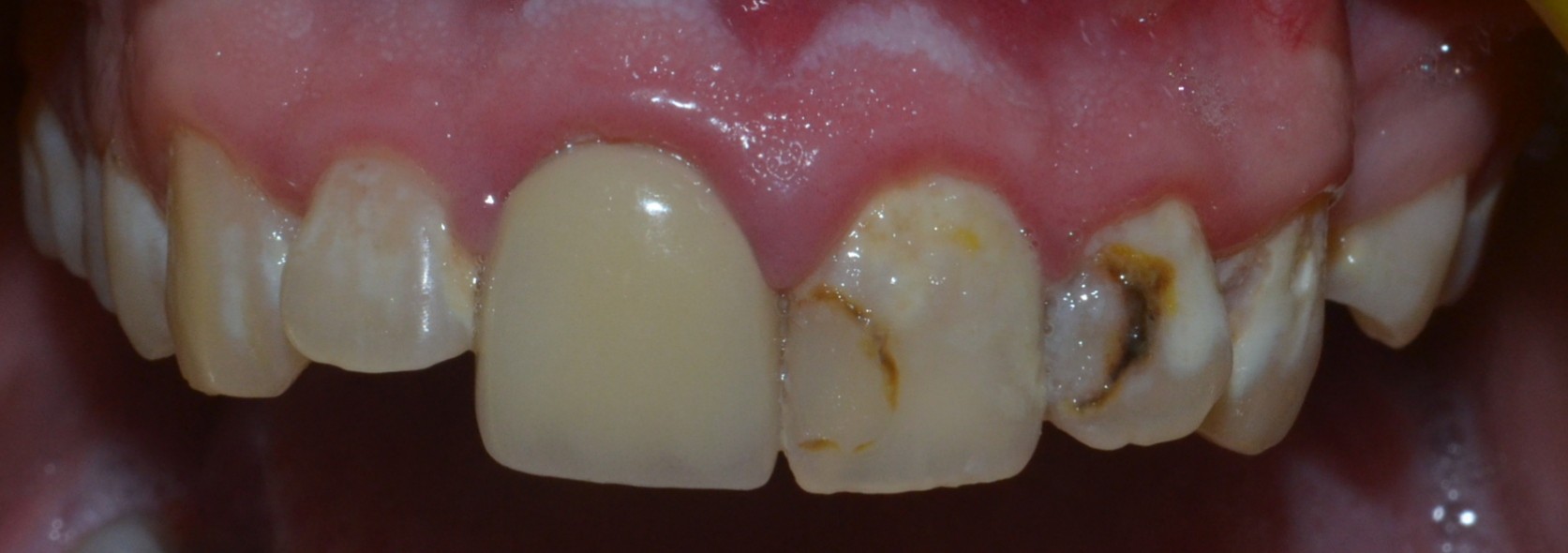 decayed discoloured teeth