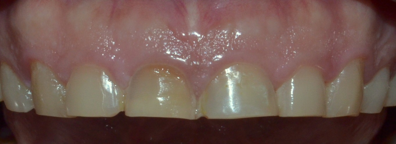 worn away teeth