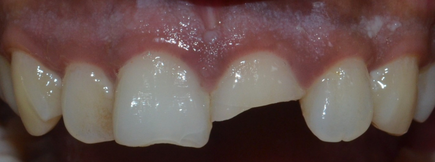 fractured tooth
