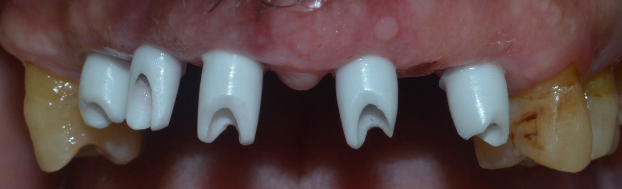 zirconia abutments on implants