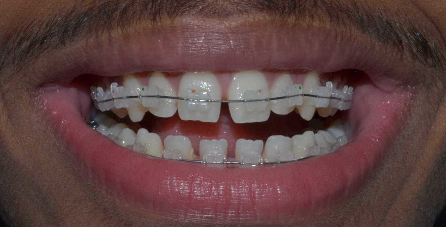 Ceramic Braces in Pune