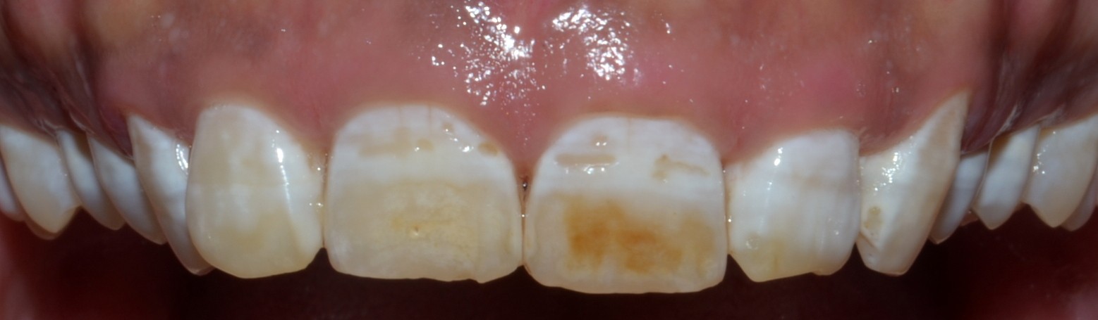discoloured teeth