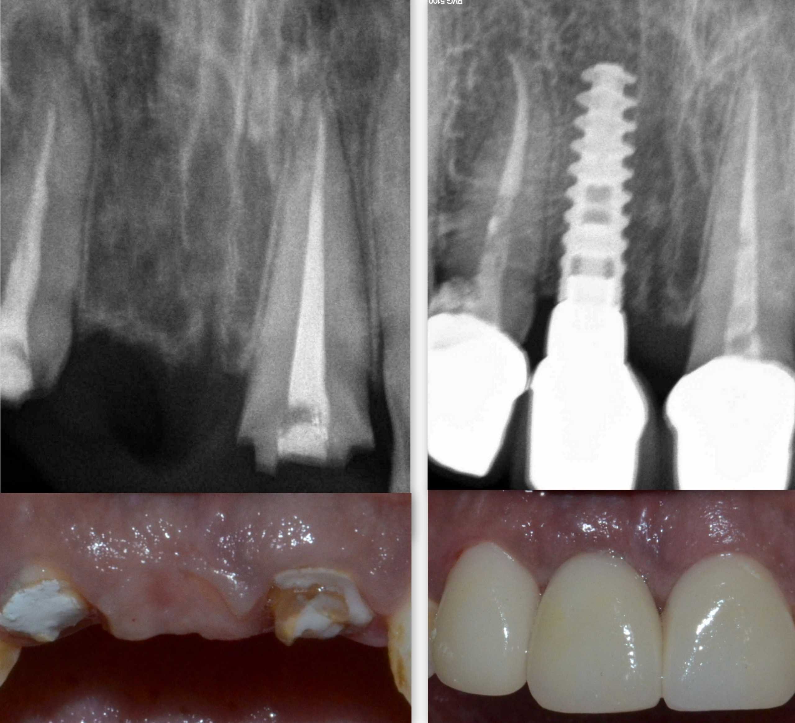 Front Tooth Dental Implant 