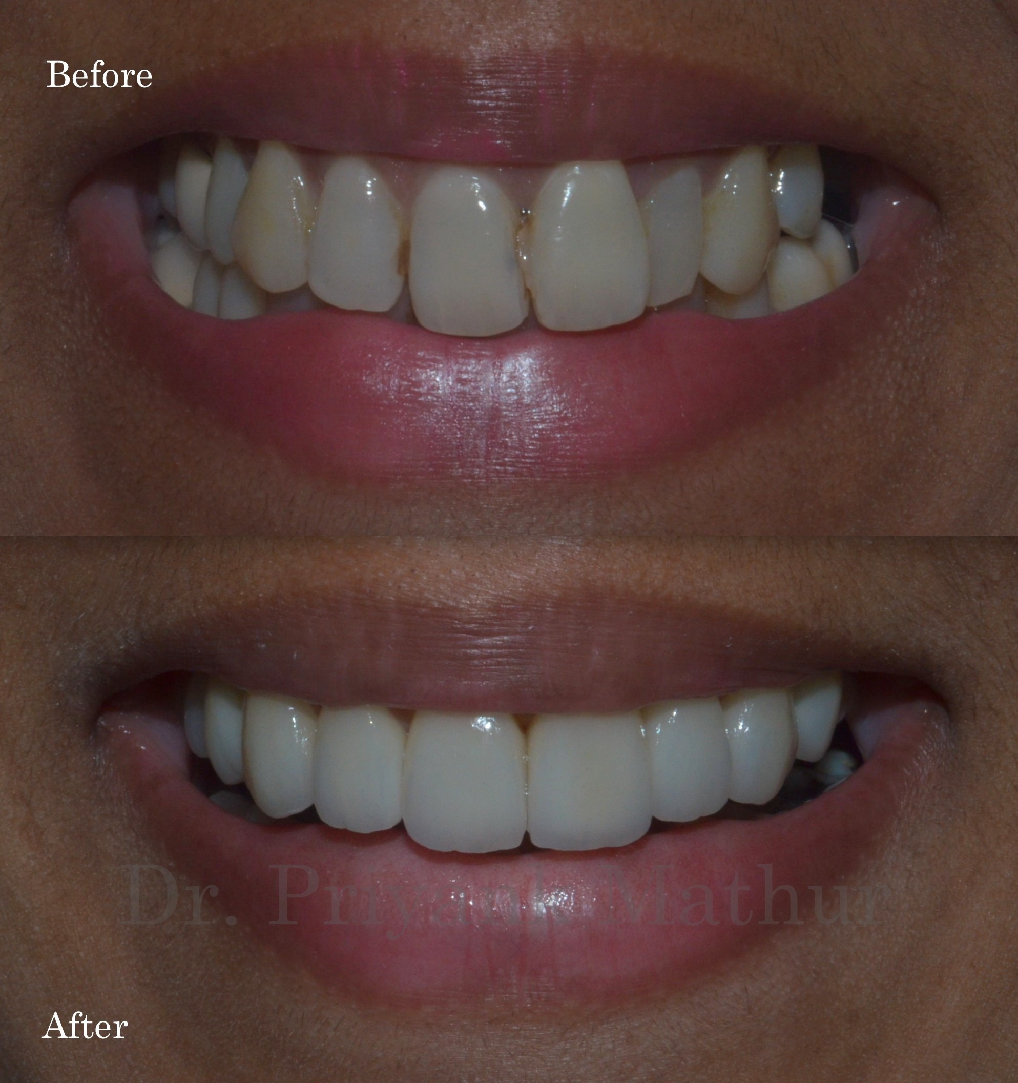 Porcelain veneers to align and brighten teeth