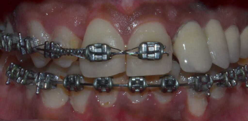 Conventional Metal Braces