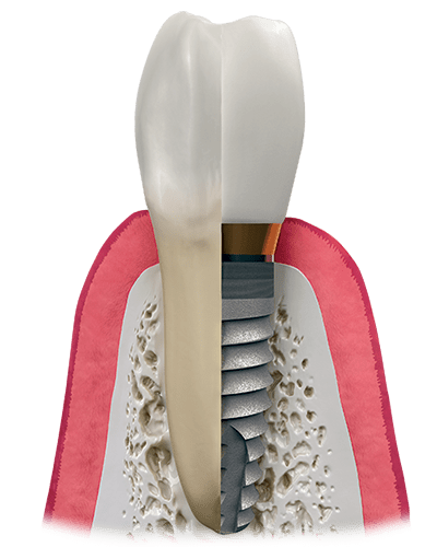 Dental implant in Pune